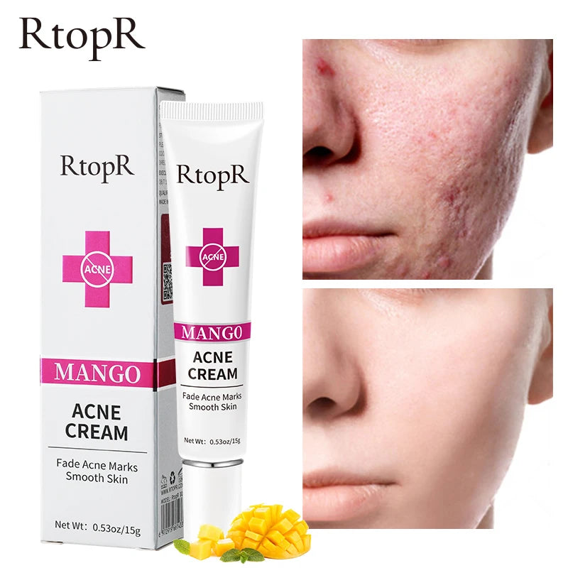 RtopR - Acne Removal Cream for Acne Marks and Repairs Damage Skin