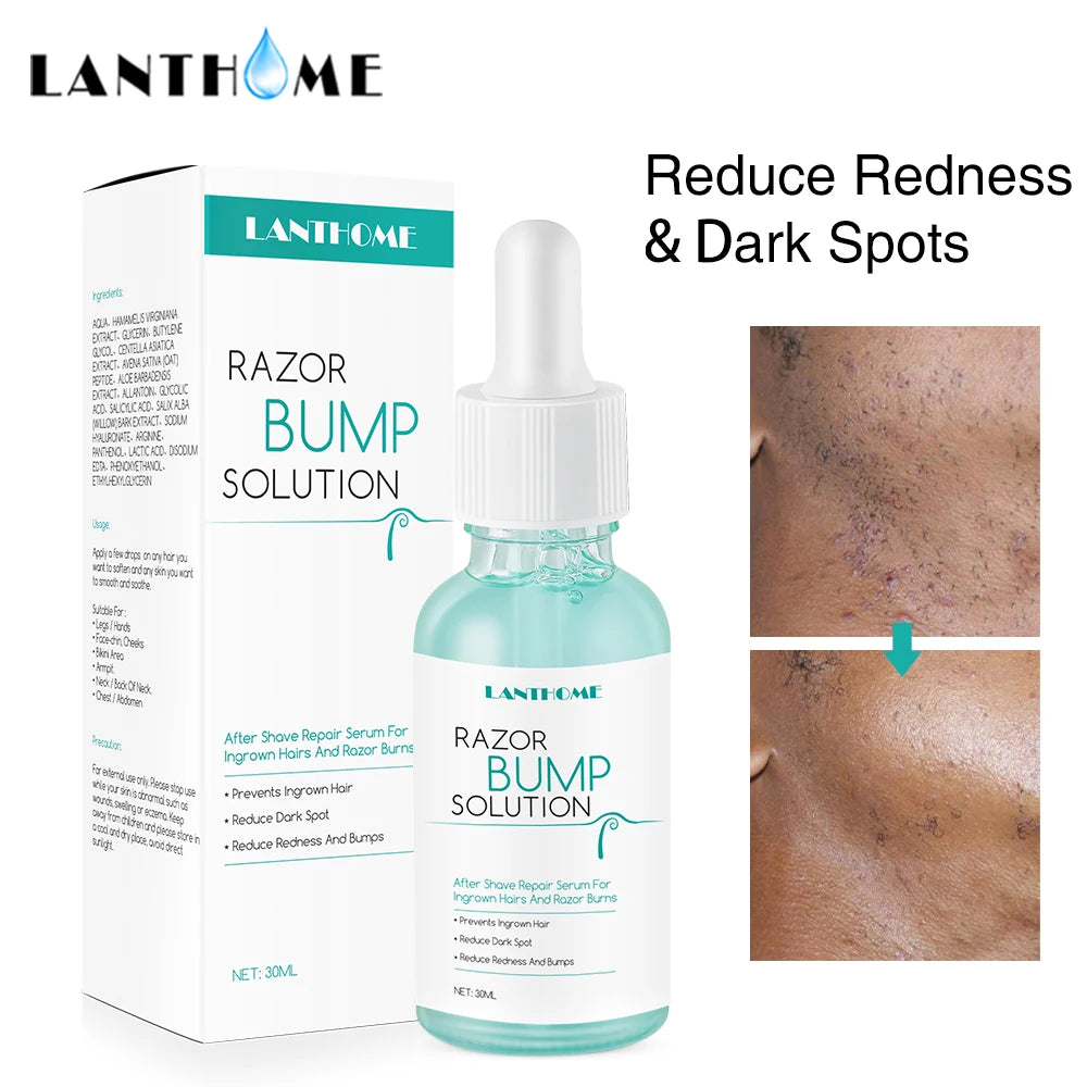 Lanthome - Body and Facial Hair Removal to Prevent Ingrown Hairs