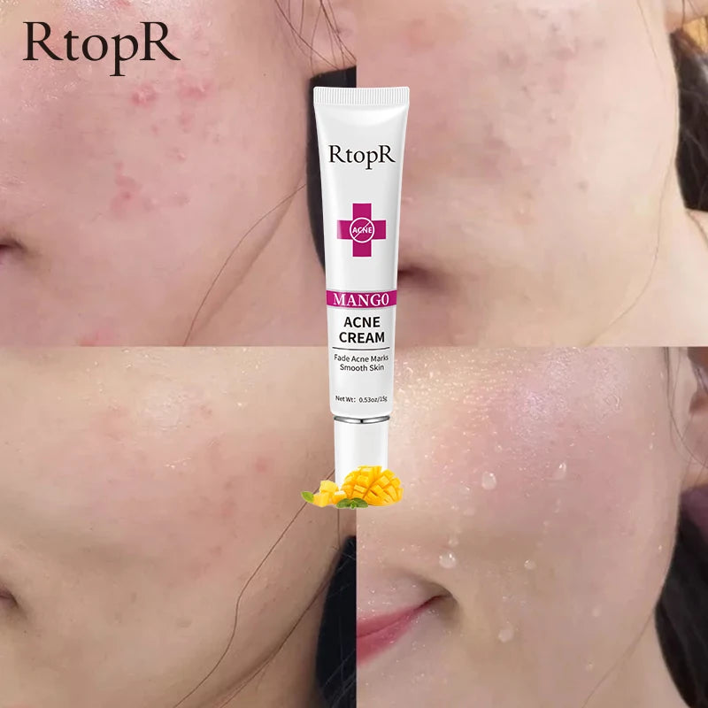 RtopR - Acne Removal Cream for Acne Marks and Repairs Damage Skin