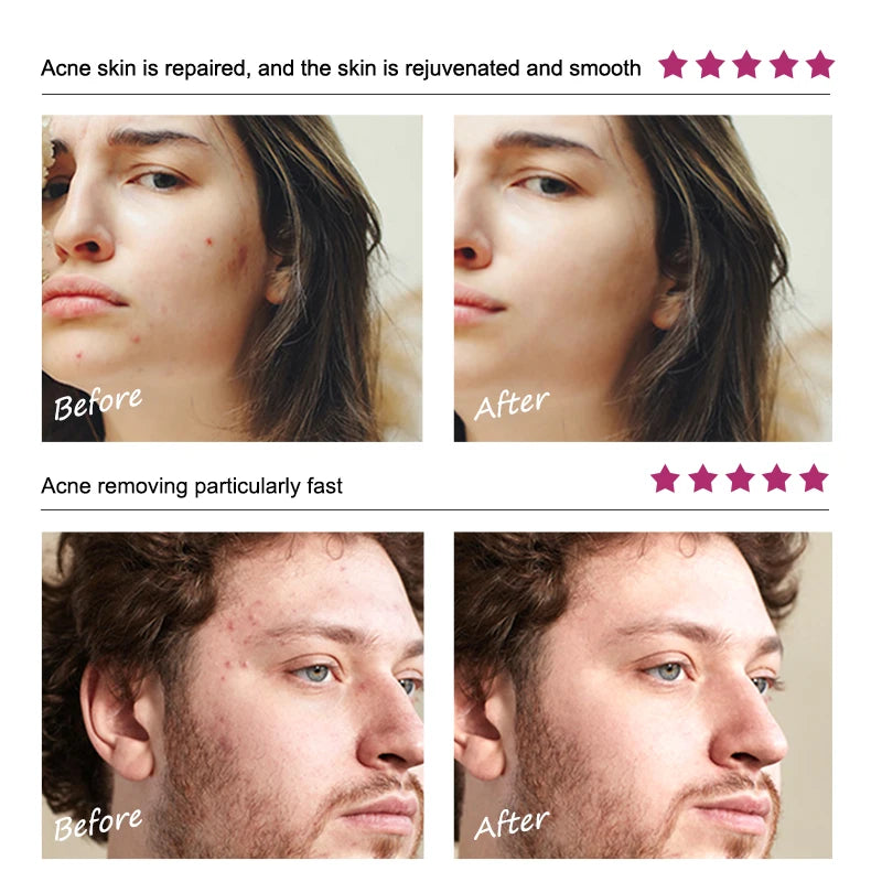 RtopR - Acne Removal Cream for Acne Marks and Repairs Damage Skin