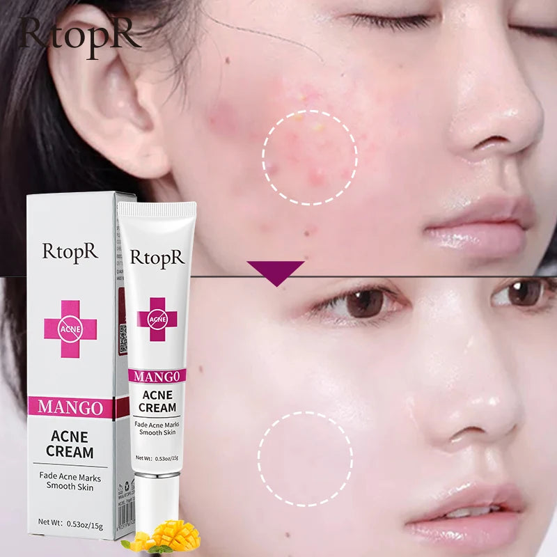 RtopR - Acne Removal Cream for Acne Marks and Repairs Damage Skin