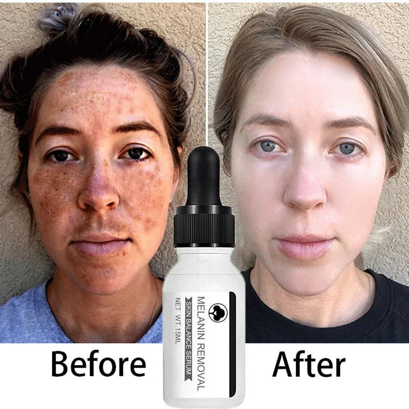 Niacinamide Serum: Dark Spot Removal & Skin Whitening