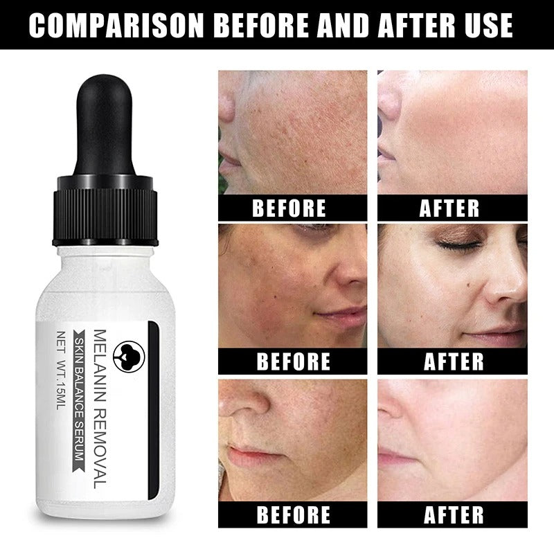 Niacinamide Serum: Dark Spot Removal & Skin Whitening