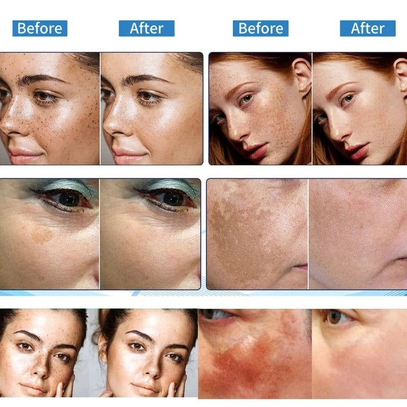 Niacinamide Serum: Dark Spot Removal & Skin Whitening