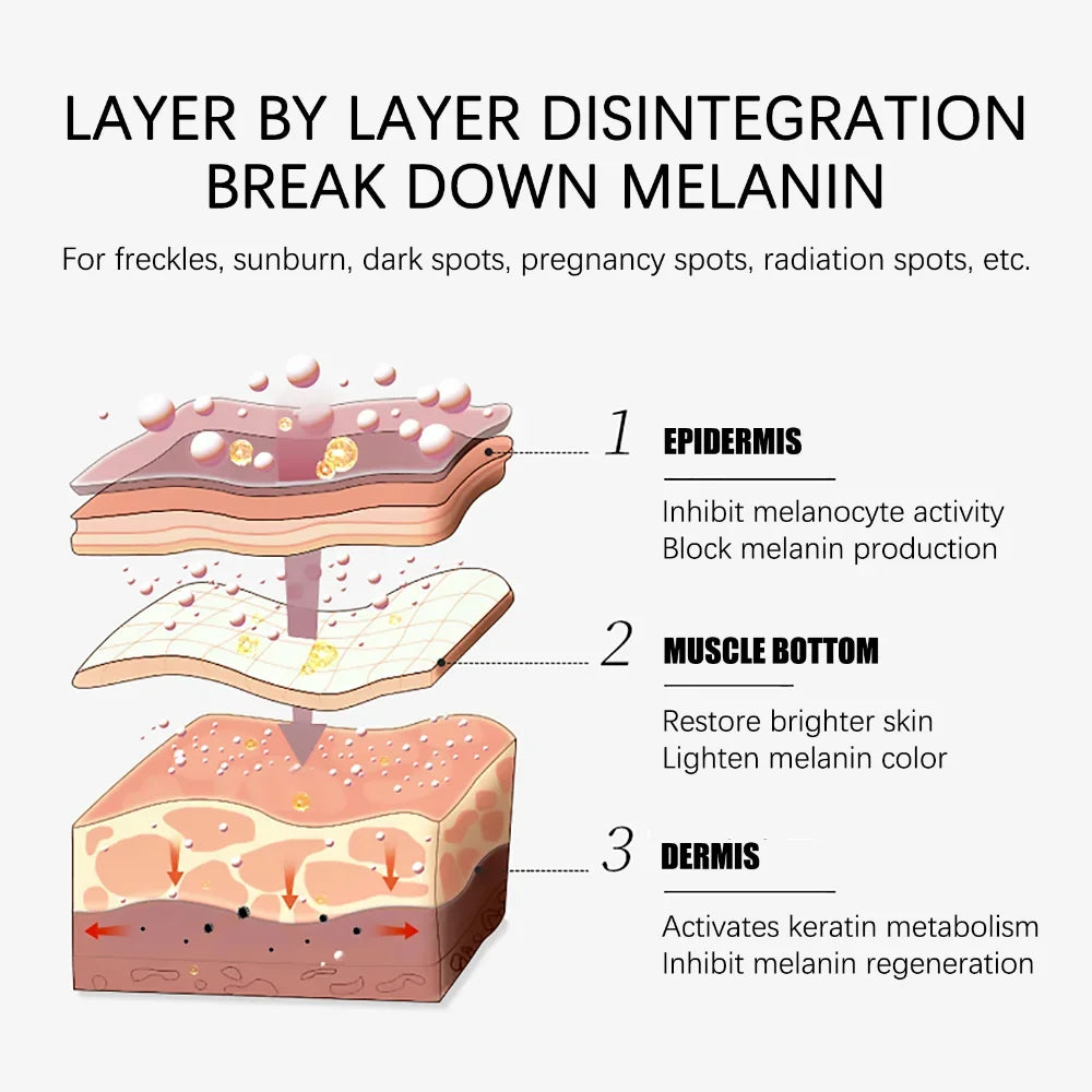 Whitening Freckles Cream for Melasma and Dark Spots