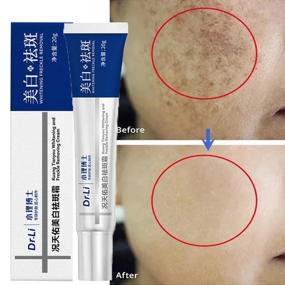 Whitening Freckles Cream for Melasma and Dark Spots