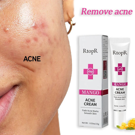 RtopR - Acne Removal Cream for Acne Marks and Repairs Damage Skin