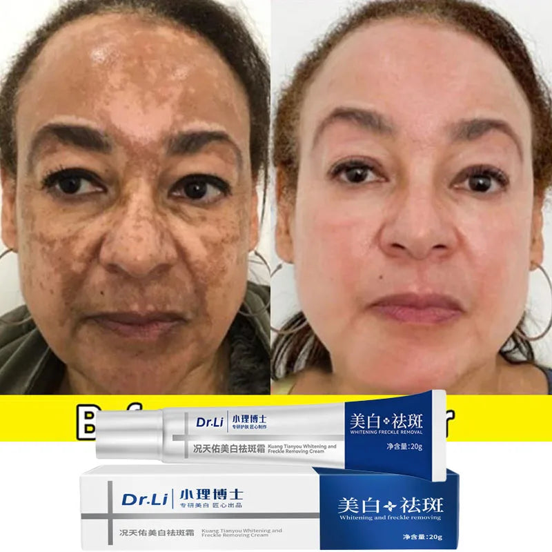 Whitening Freckles Cream for Melasma and Dark Spots