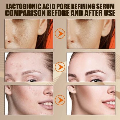 EELHOE Lactobionic Acid Pore Serum: Skin Repair & Blackhead Removal